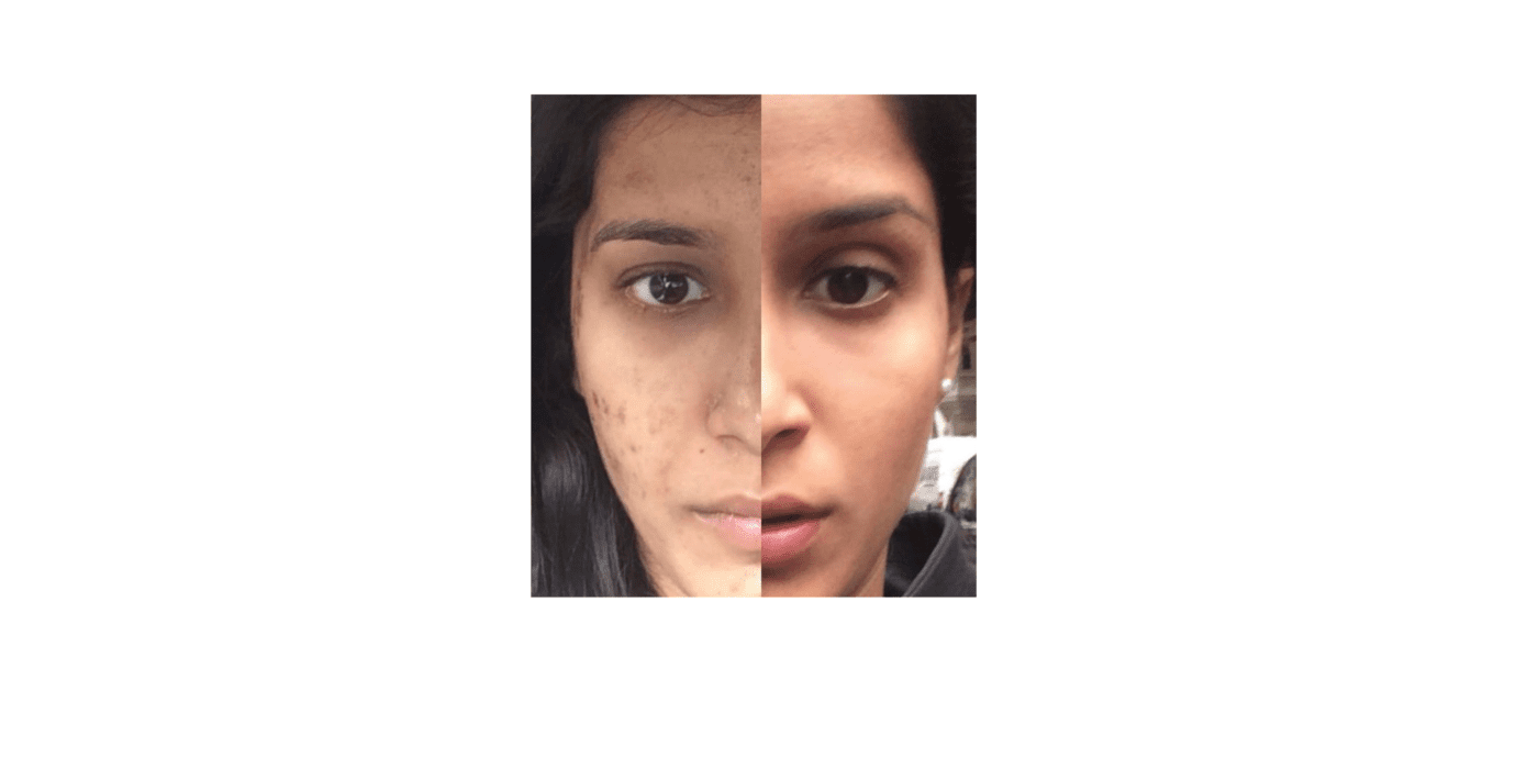 My journey with adult acne